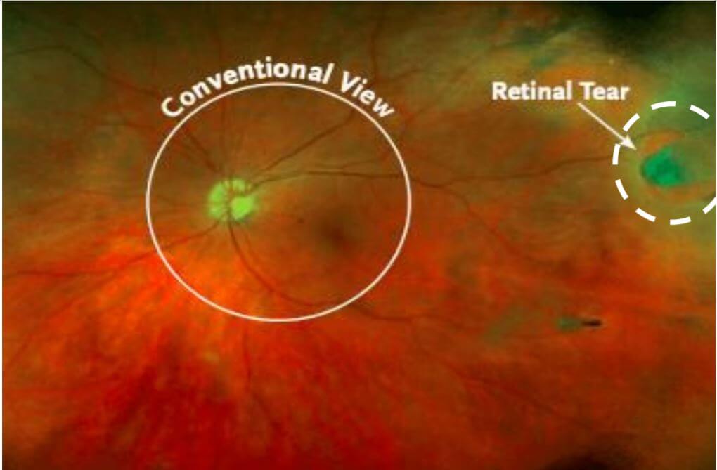 hole in retina without detachment